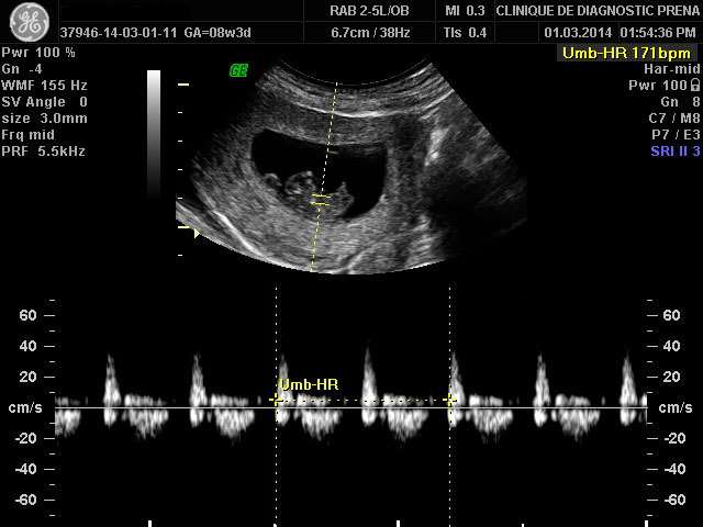 Echographie obstétricale de grossesse du TROISIEME TRIMESTRE chez la femme  enceinte sans ordonnance - Centre de santé du Marais